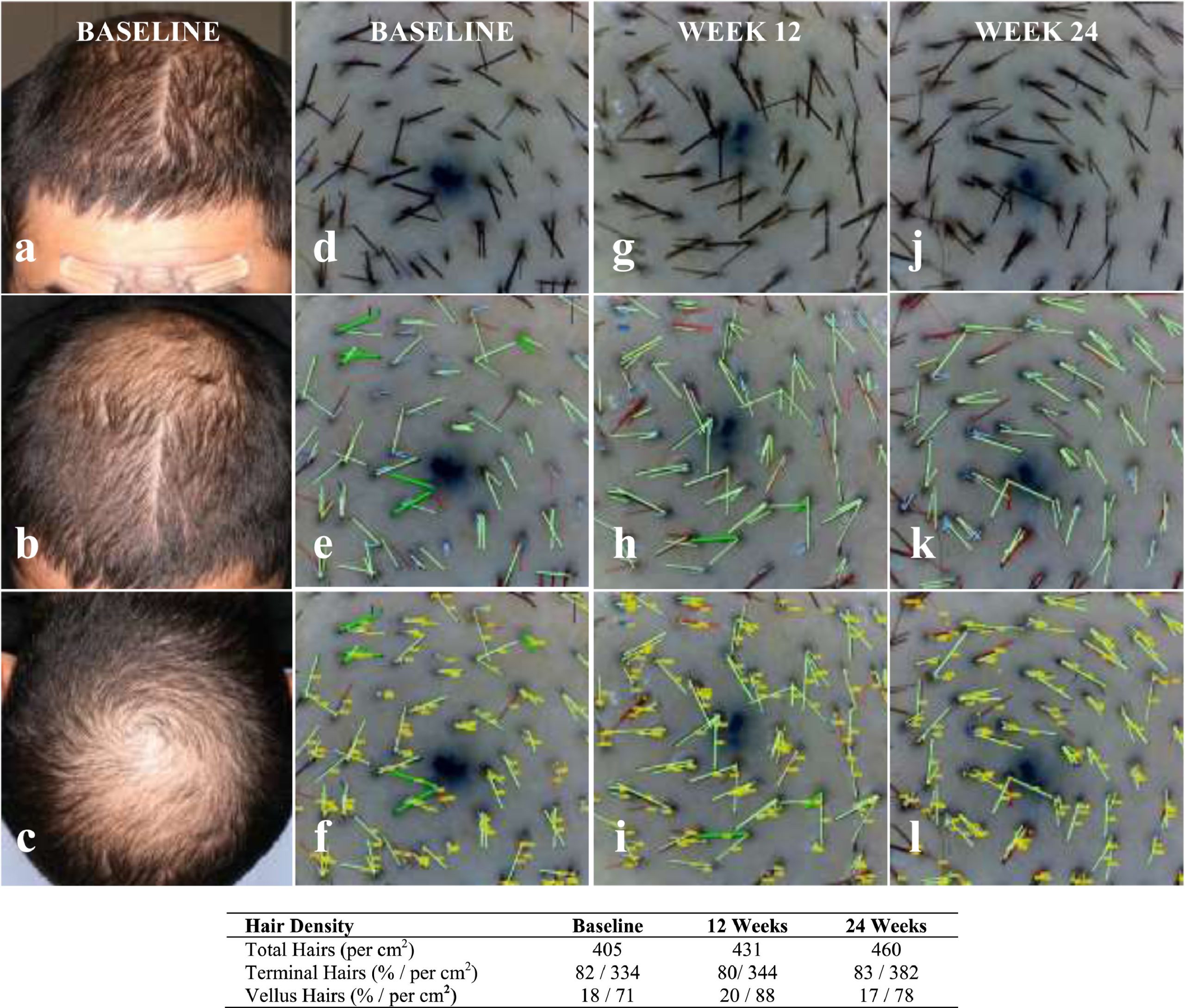 Max Wax for Hair Samples Of Resume Objectives Safety and Efficacy Of Alrv5xr In Men with androgenetic Alopecia …