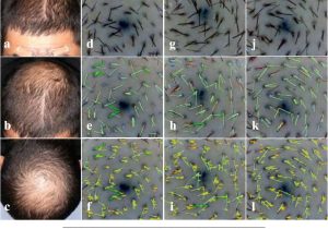 Max Wax for Hair Samples Of Resume Objectives Safety and Efficacy Of Alrv5xr In Men with androgenetic Alopecia …